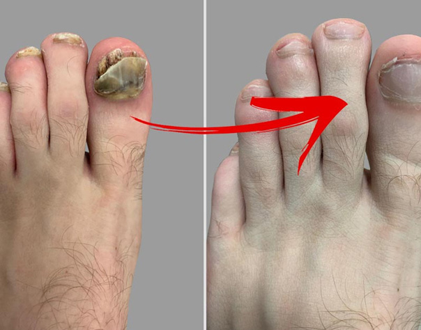 Laser Therapy For Toenail Fungus